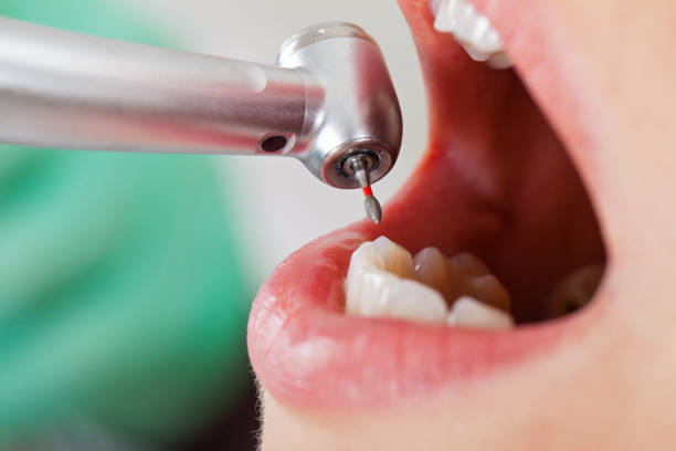 Best Broken or Cracked Tooth Emergency Dentist in Port Sulphur, LA